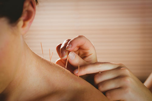 Dry needling treatment on the shoulder